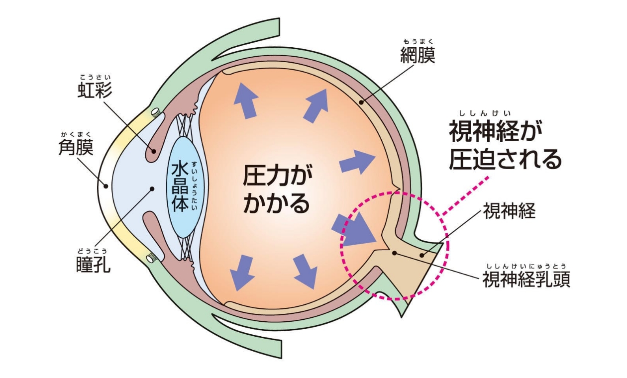 眼圧が高い状態