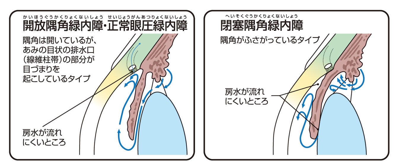 レーザー治療