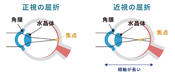 近視について