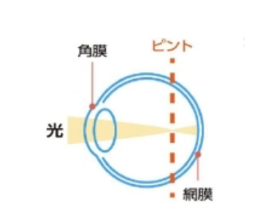 オルソケラトロジーの仕組み