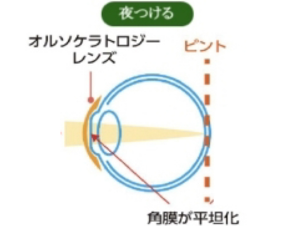 オルソケラトロジーの仕組み