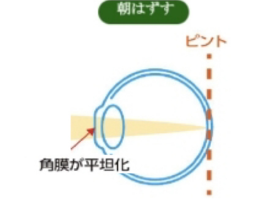 オルソケラトロジーの仕組み