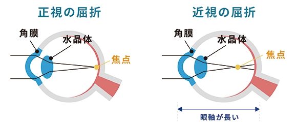 近視について